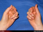 Polyarthrite rhumatoïde, PR débutante, PR ; reconnaître l’atteinte inflammatoire précoce de la main ; face ventrale de la main