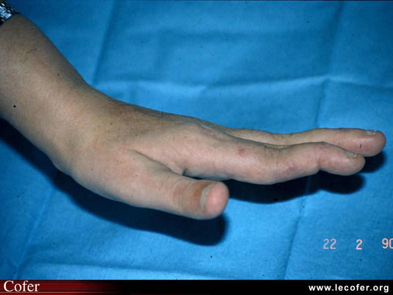 Polyarthrite rhumatoïde – PR établie ; atteinte des doigts : les déformations élémentaires ; déformation de l'index en col de cygne avec hyperextension de l'IPP et flexion de l'IPD (déplacement dorsal du système extenseur). 0201010025.jpg