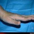 Polyarthrite rhumatoïde, PR ; atteinte des doigts : déformation des doigts en col de cygne