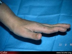 Polyarthrite rhumatoïde, PR ; atteinte des doigts : déformation des doigts en col de cygne