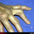 Polyarthrite rhumatoïde, PR ; atteinte des doigts, déformation d’un doigt en boutonnière