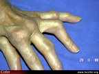 Polyarthrite rhumatoïde, PR ; atteinte des doigts, déformation d’un doigt en boutonnière