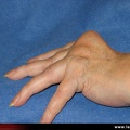 Polyarthrite rhumatoïde, PR ; atteinte des doigts : les déformations élémentaires ; déformation d’un doigt en maillet