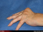 Polyarthrite rhumatoïde, PR ; atteinte des doigts : les déformations élémentaires ; déformation d’un doigt en maillet