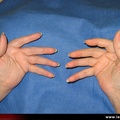 Polyarthrite rhumatoïde, PR ; atteinte des doigts : les déformations élémentaires ; coup de vent cubital