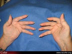 Polyarthrite rhumatoïde, PR ; atteinte des doigts : les déformations élémentaires ; coup de vent cubital
