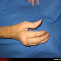 Polyarthrite rhumatoïde, PR ; atteinte des doigts : pouce en Z