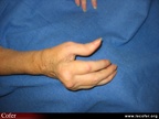 Polyarthrite rhumatoïde, PR ; atteinte des doigts : pouce en Z