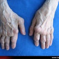 Polyarthrite rhumatoïde, PR ; atteinte des doigts : pouce adductus