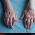 Polyarthrite rhumatoïde, PR ; atteinte du poignet : poignet en dos de chameau