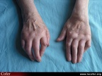 Polyarthrite rhumatoïde, PR ; atteinte du poignet : poignet en dos de chameau