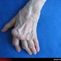 Polyarthrite rhumatoïde, PR ; aspect évolué des déformations : main rhumatoïde ancienne