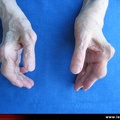 Polyarthrite rhumatoïde – PR établie ; complications à la main ; amyotrophie thénar