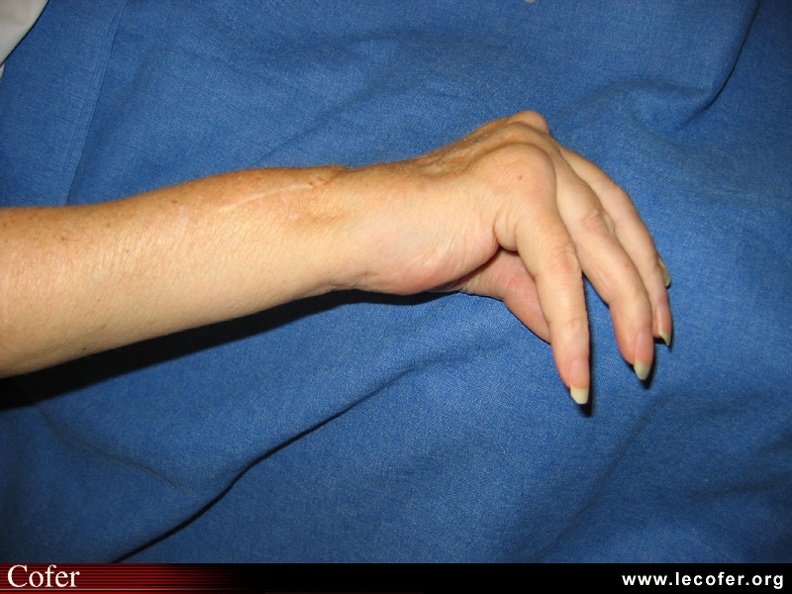 Polyarthrite rhumatoïde – PR établie ; complications à la main ; rupture des tendons extenseurs