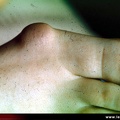 Polyarthrite rhumatoïde, PR ; atteinte de l’avant-pied ; hallux valgus