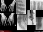 Rhumatisme psoriasique : différents aspects radiologiques de l’atteinte des doigts ou des orteils