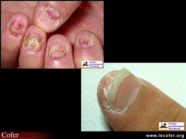 Psoriasis / Psoriasis unguéal / Psoriasis des ongles