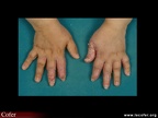 Psoriasis des doigts