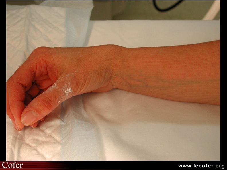 Déformation clinique du poignet, de profil, après une fracture de Pouteau-Colles. 050101005.jpg