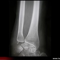 Radiographie normale du radius de face