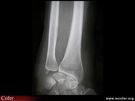 Radiographie normale du radius de face