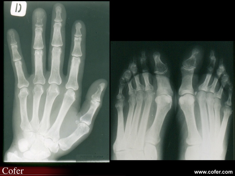 Métastases osseuses : à gauche : lyse des phalanges terminales des 1er, 4ème et 5ème doigts ; à droite : lyse de la phalange terminale de l'hallux gauche. 050302041.jpg
