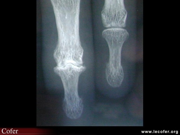 Arthrose digitale : nodule d’Heberden : radiographie