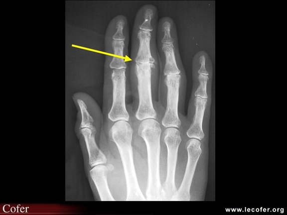 Arthrose digitale : nodule de Bouchard : radiographie