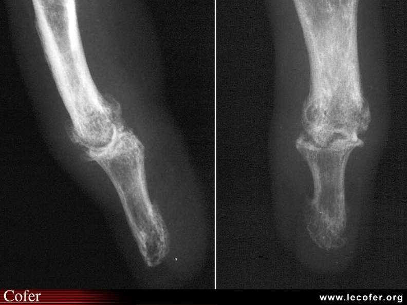 Association arthrose digitale et goutte féminine