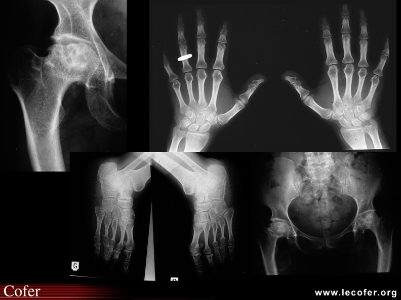 Dysplasie polyépiphysaire, dysplasie du col avec remaniement dégénératif, les phalanges des mains et des pieds sont porteuses de déformations caractéristiques à type de phalanges « massives ». 090400006.jpg