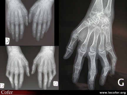 Polyarthrite juvénile facteur rhumatoïde positive : évolution radiographique de l’atteinte des mains