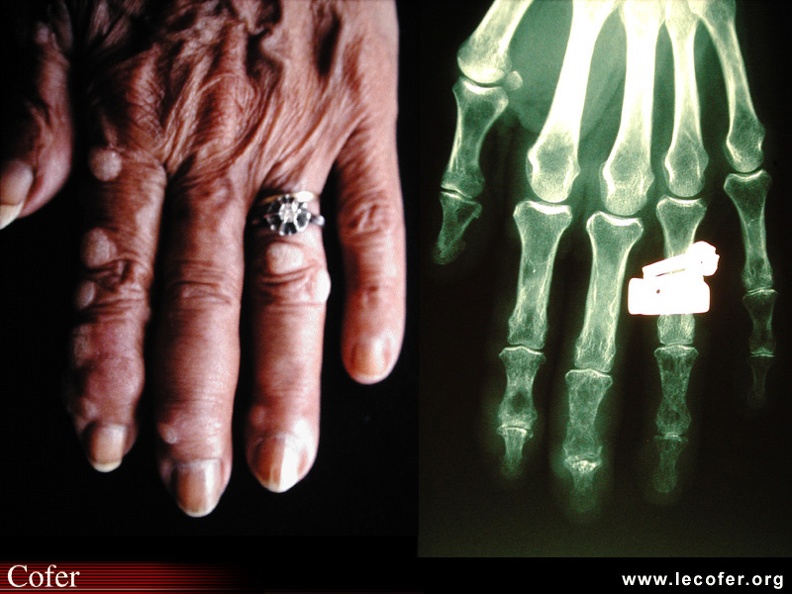 Sarcoïdose : Nombreux sarcoïdes cutanés des doigts. Aspect tuméfié des phalanges II, III et IVème rayons gauches, lié à l'ostéite de Jüngling sous-jacente (zoom). BB012.jpg