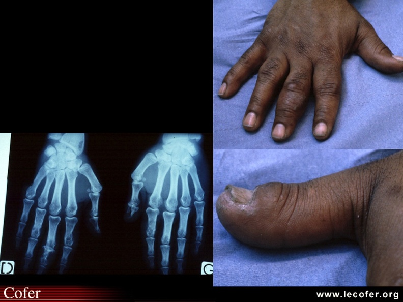 Sarcoïdose : Pas de lésion cutanée ni unguéale. Aspect tuméfié, élargi des phalanges 1 des deuxième et quatrième doigts et phalange 2 du troisième doigt de la main droite et acro-ostéolyse du pouce gauche, lié à l'ostéite de Jüngling sous-jacente. BB014.jpg