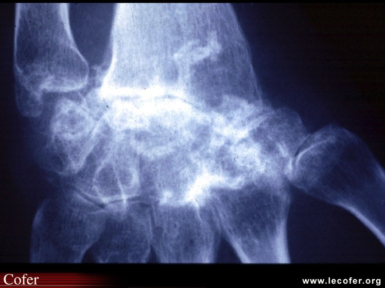 Carpite fusionnante isolée dans le cadre d'une MSA. Contrairement à ce qui est observé dans la PR, cette atteinte est isolée sans érosions des articulations MCP ou IPP. SA014.jpg