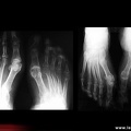Algoneurodystrophie, algodystrophie du pied : radiographies