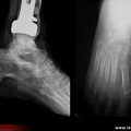 Algodystophie, algoneurodystrophie du pied : aspect radiologique