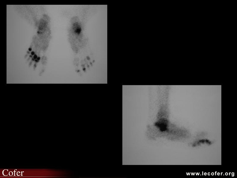 Rhumatisme psoriasique : anomalies scintigraphiques. 000000000394.jpg
