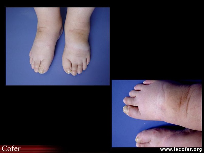 Polyarthrite œdémateuse, syndrome RS3PE. 000000000499s.jpg