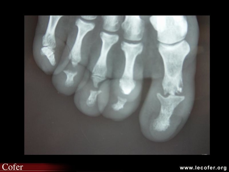 Psoriasis / rhumatisme inflammatoire / rhumatisme psoriasique / arthrite psoriasique. 000000000501s.jpg