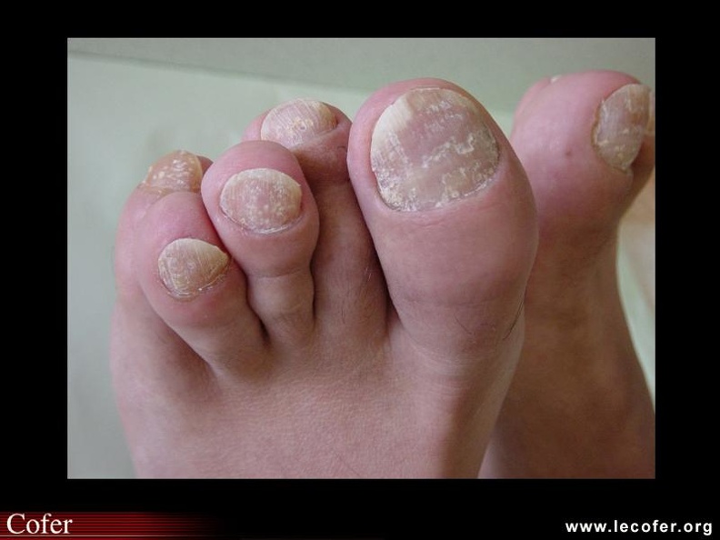 Rhumatisme psoriasique. 000000000502s.jpg