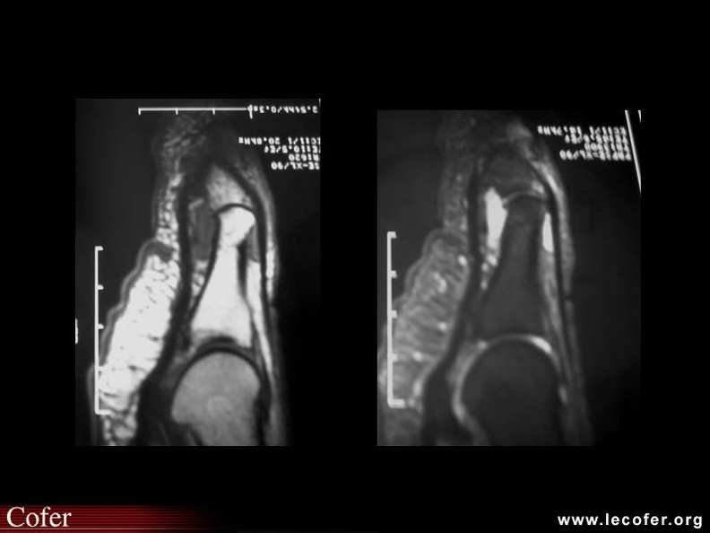 Rhumatisme psoriasique : arthrite interphalangienne du gros orteil (IRM)