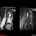 Rhumatisme psoriasique : arthrite interphalangienne du gros orteil (IRM)