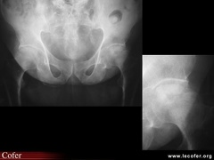 Ostéonécrose aseptique de la hanche gauche