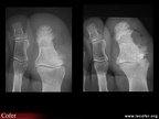 Rhumatisme psoriasique, arthrite et périostose du gros orteil (rhumatisme psoriasique)