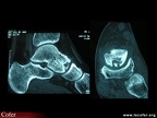 Ostéonécrose aseptique du talus