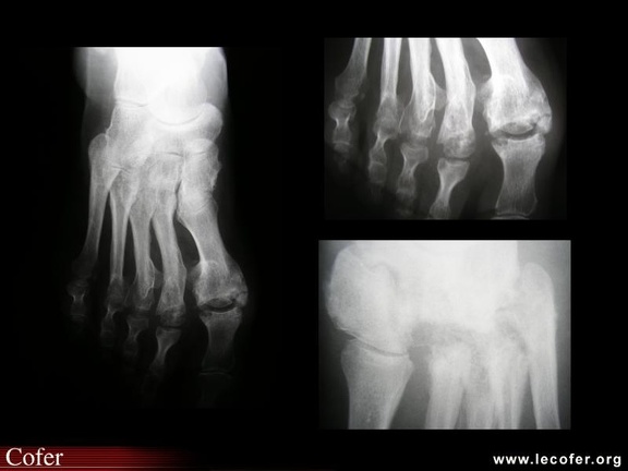 Ostéoarthropathie nerveuse du pied