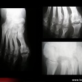 Ostéoarthropathie nerveuse du pied