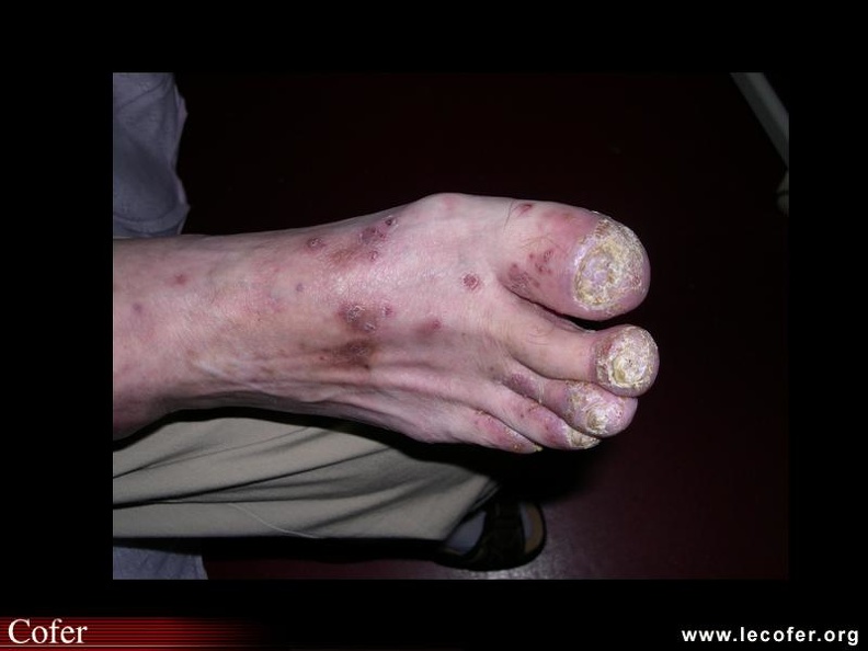 Psoriasis unguéal et cutané. 000000000791s.jpg