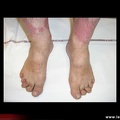 Rhumatisme psoriasique