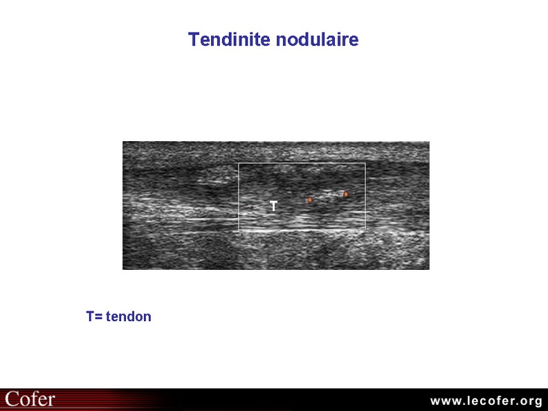 Tendinite du tendon d'Achille, échographie